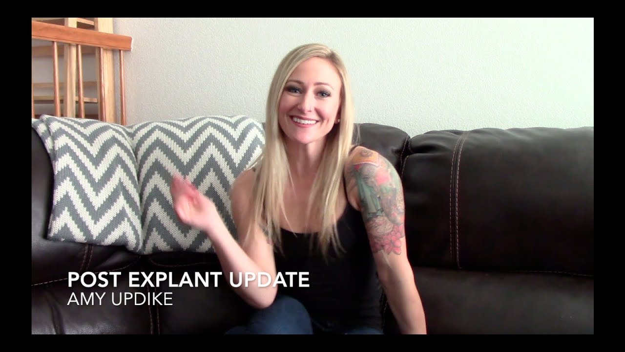 11 months Post Explant Update