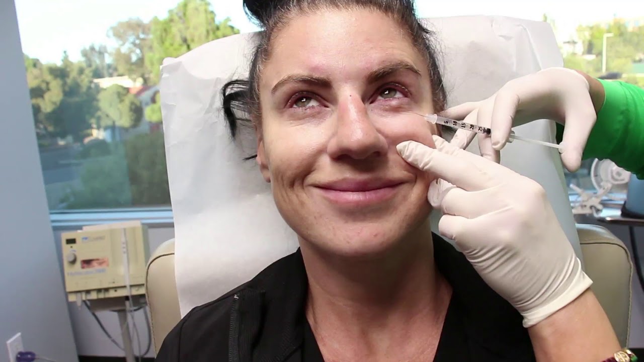 Dysport Injections to the Glabella, Crow's Feet and Bunny Lines