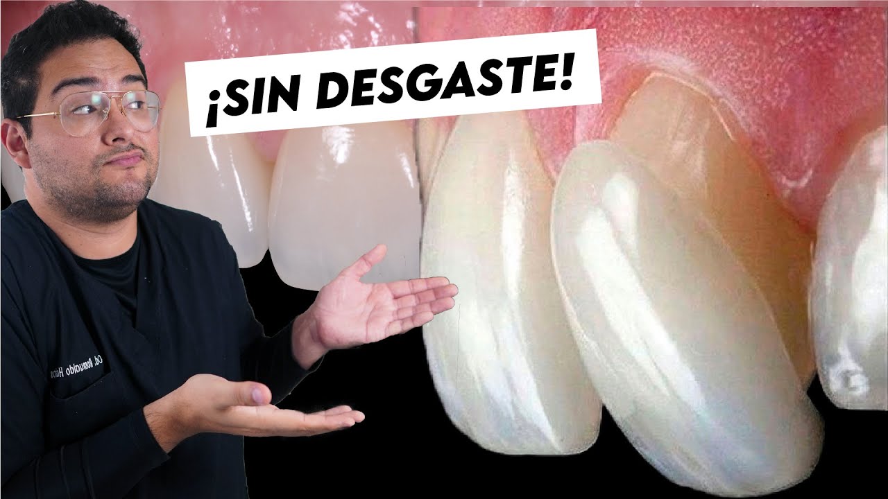 CARILLAS DENTALES: LO QUE NADIE TE DICE &iquest;PORQUE NO DESGASTAR? &iquest;TE QUEDAS SIN DIENTES?