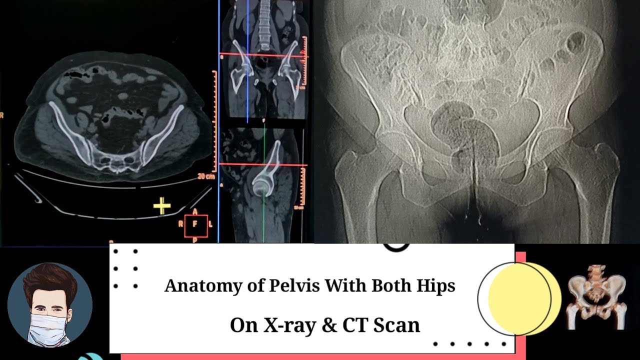 Anatomy of Pelvis With Both Hips | X-ray & CT scan | By Anis Qureshi