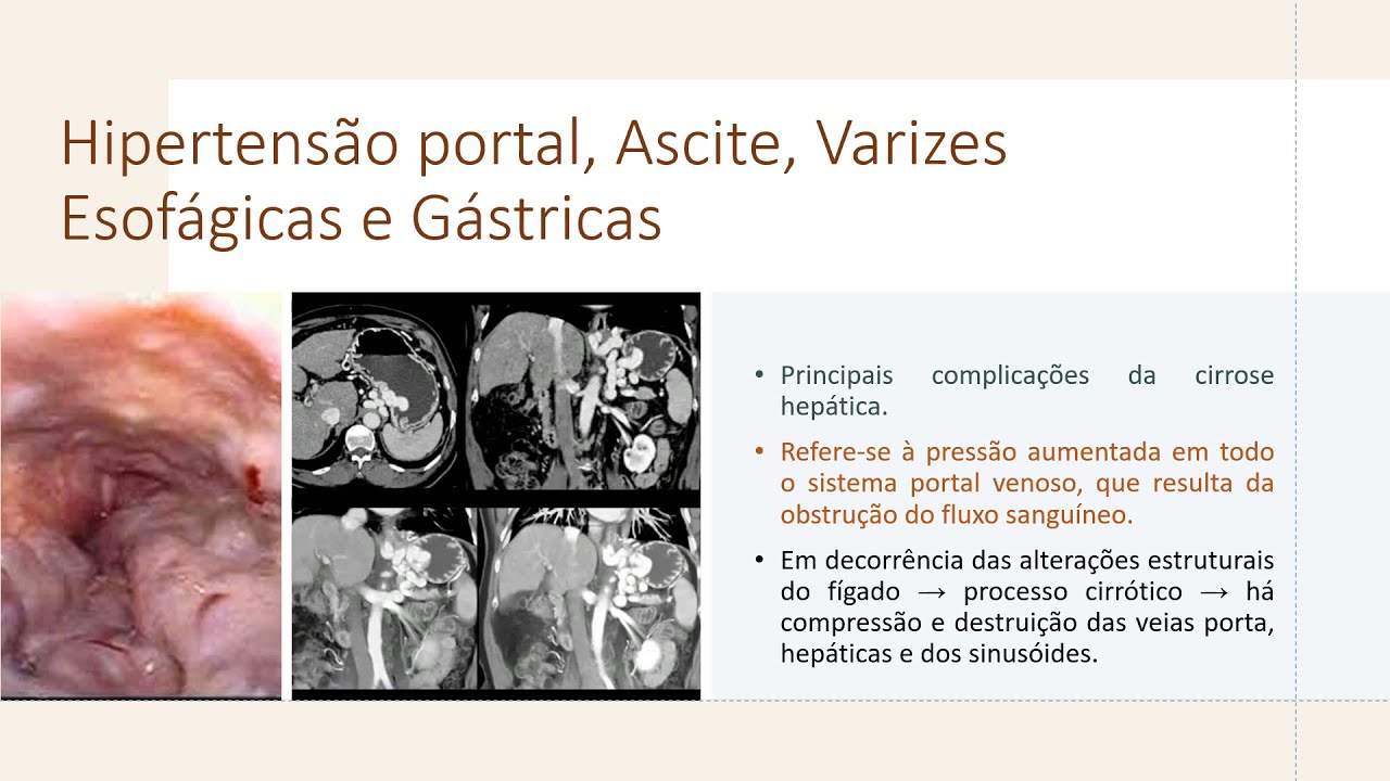 Hipertensão Portal,  Ascite, Varizes Esofágicas e
