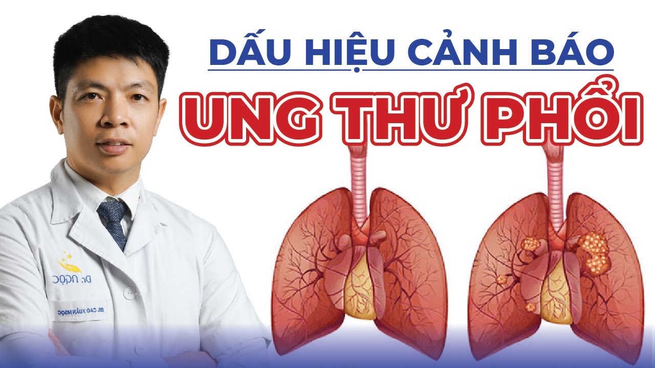 6 Dấu Hiệu Cảnh Báo Tình Trạng Ung Thư Phổi | Dr Ngọc