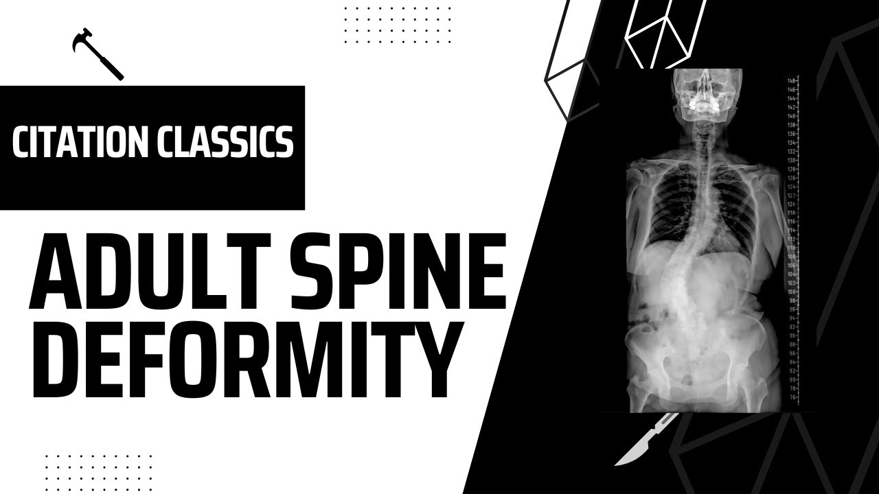 Spine Citation Classics: 05 Adult Spine Deformity