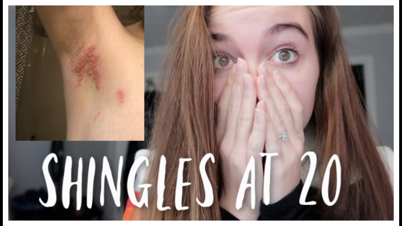 Getting Shingles At 20 Years Old
