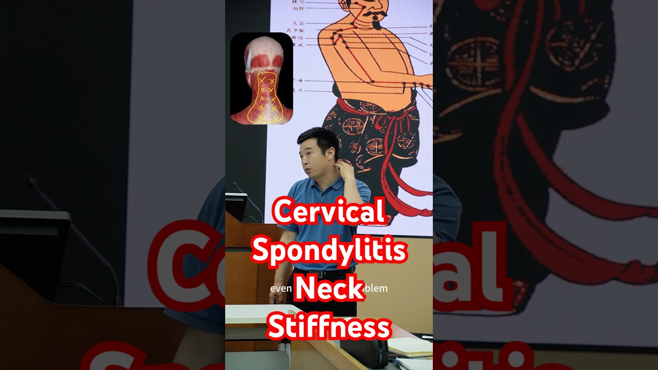 Cervical Spondylosis and Nexk Stiffness #tcm #doctor #healthtips #acupressure #spondylitis #neckpain