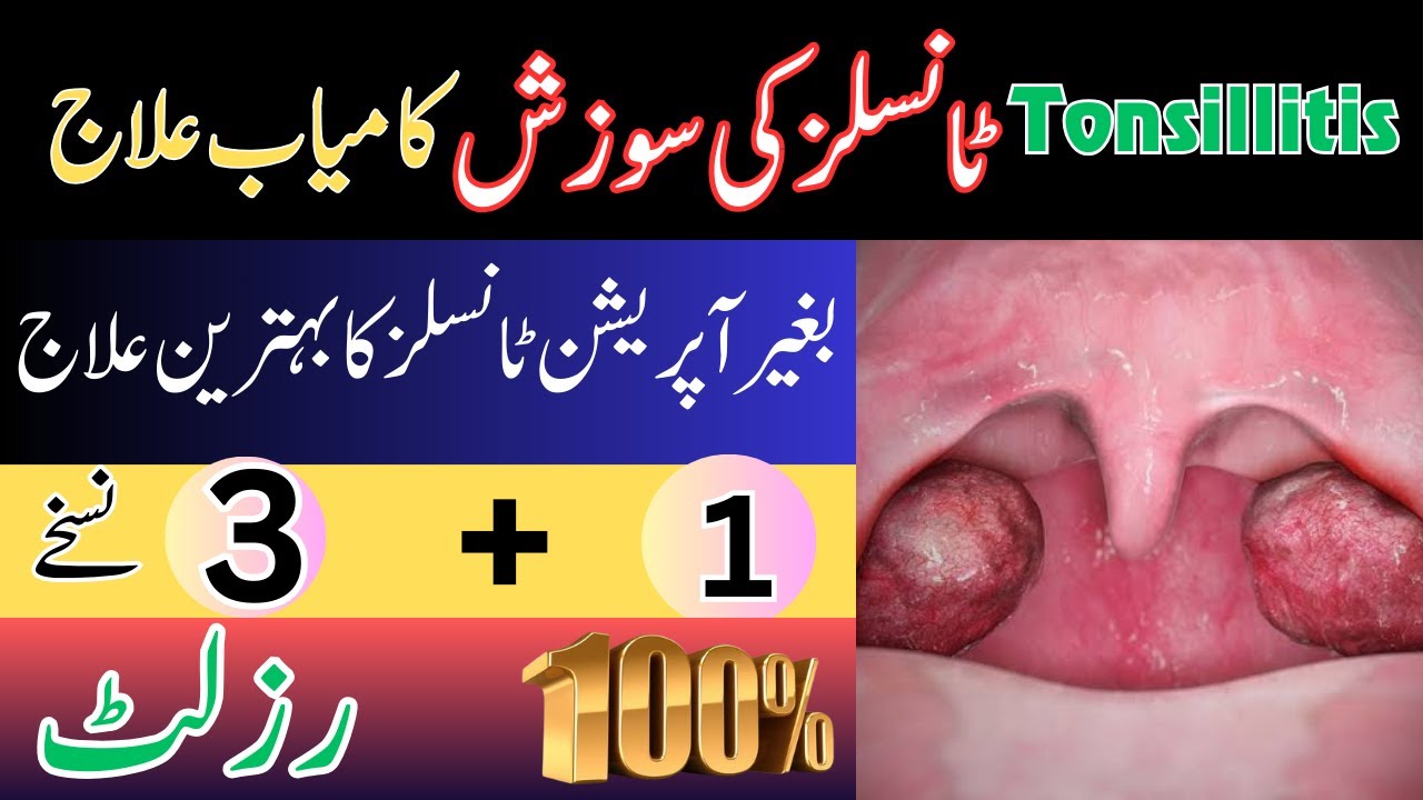 Galay ma dard ka fori ilaj | Tonsillitis Treatment | Homeotips by Doctor akram