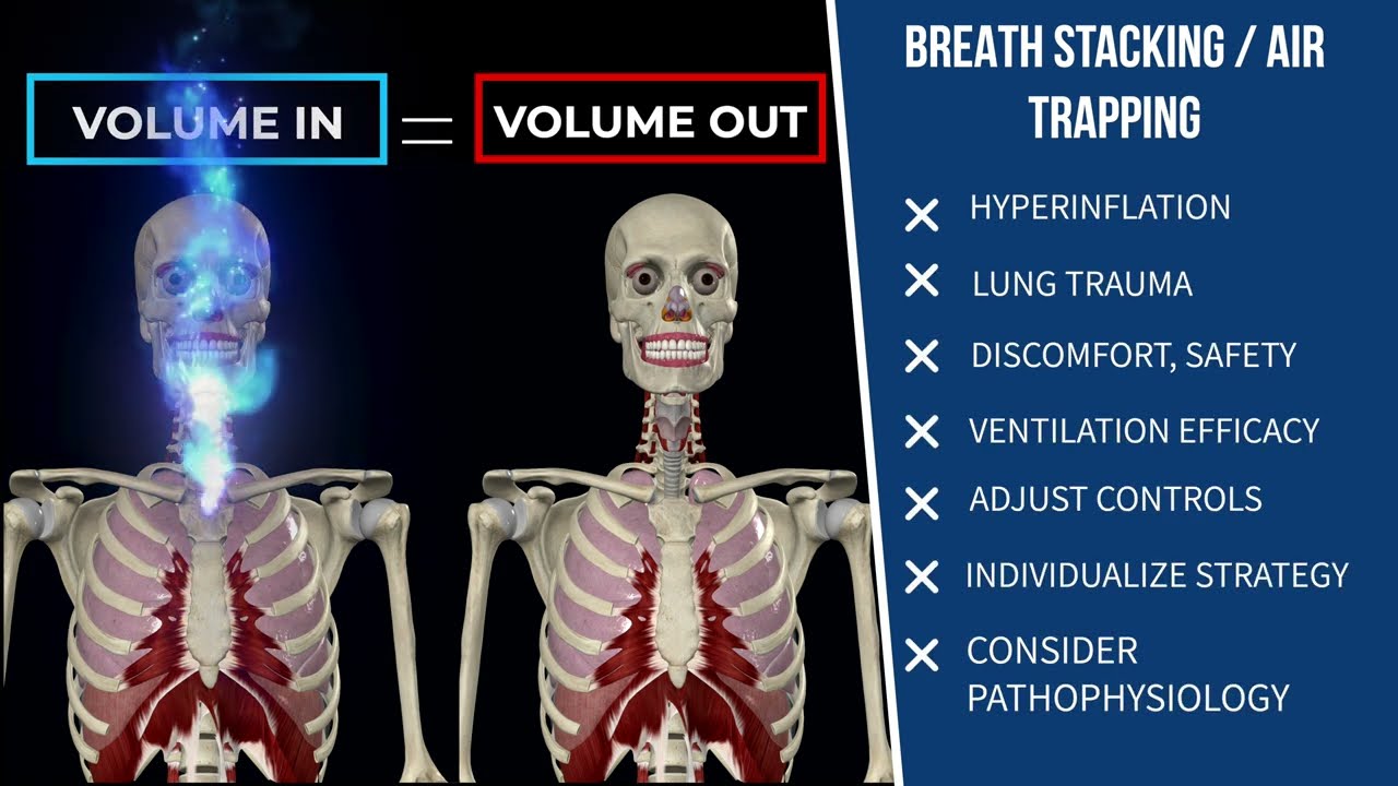 Mechanical Ventilation - Alarm Management, Part 1