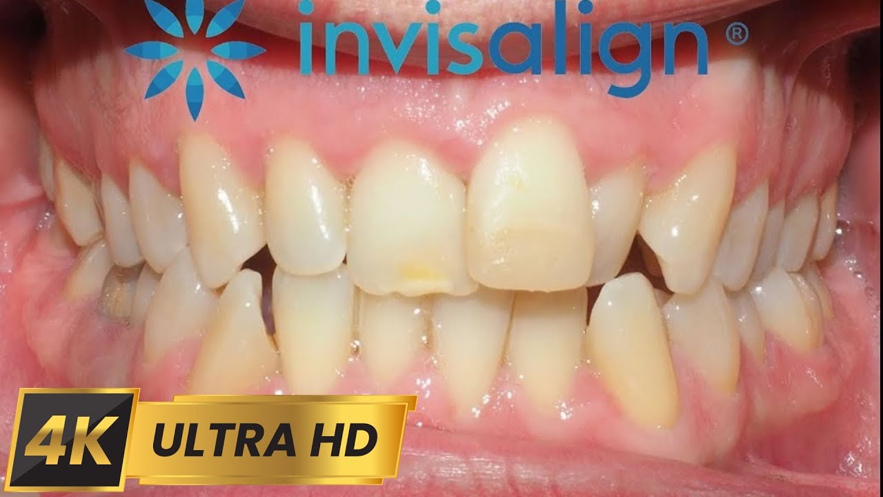 INVISALIGN treatment for 10 MONTHS! 4k time-lapse.