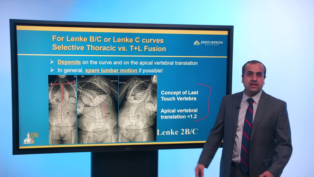Adolescent Idiopathic Scoliosis Case Presentation for Orthopaedic Providers