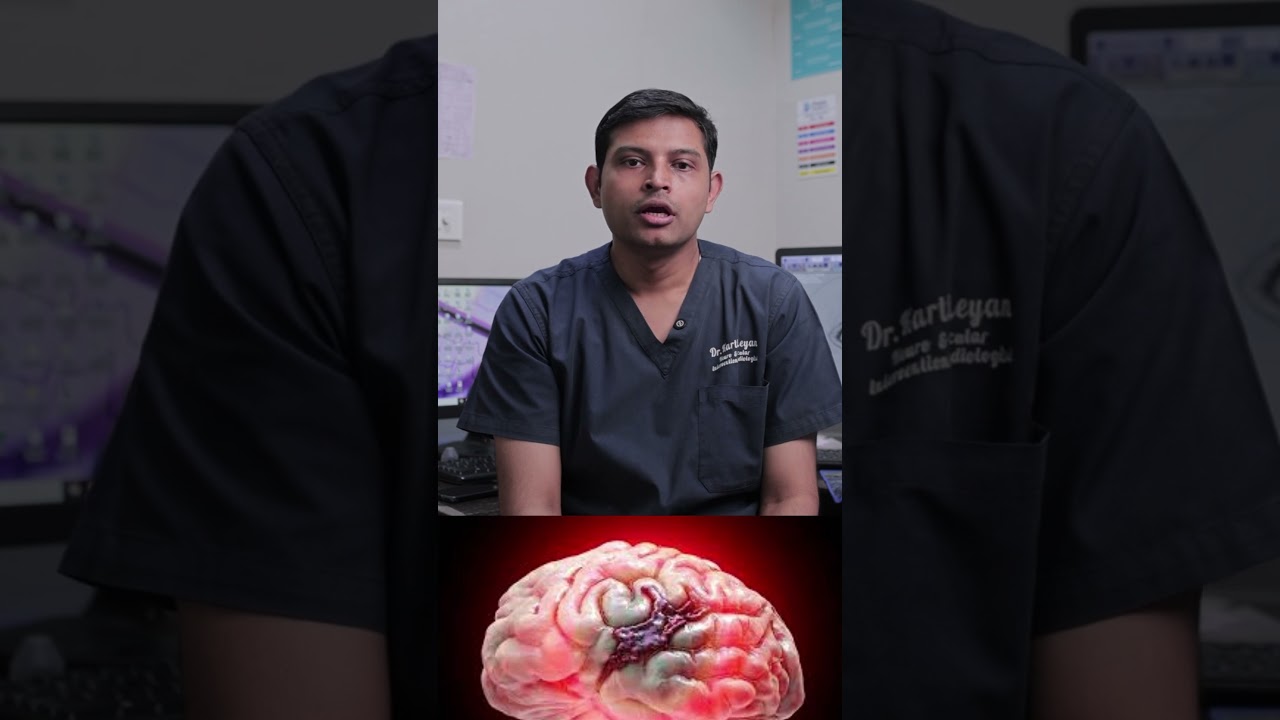 Understanding Brain Arteriovenous Malformation (AVM)