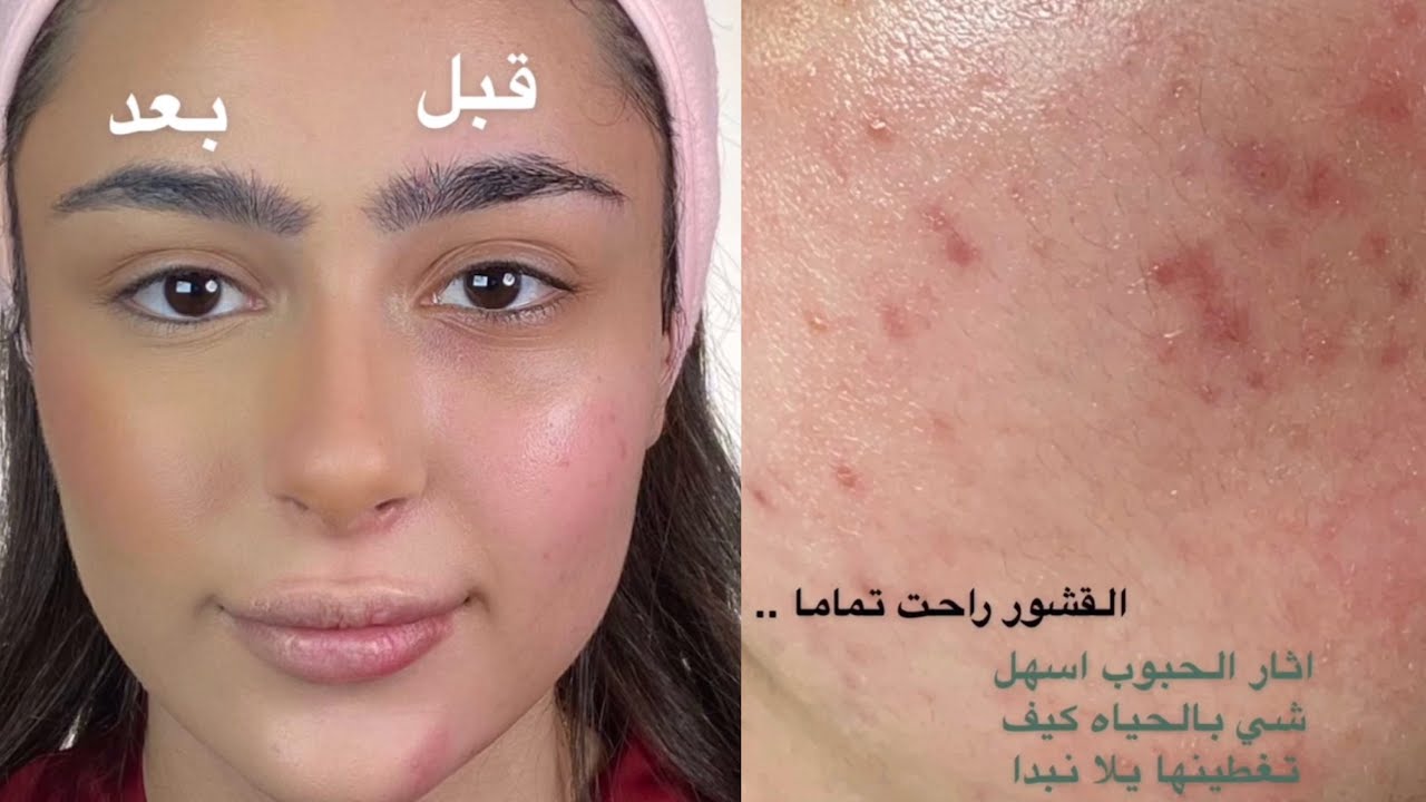ميك اب توتريال للبشرة الدهنية الي تعاني من حب الشباب واثار حب وقشور سناب وعد التركي
