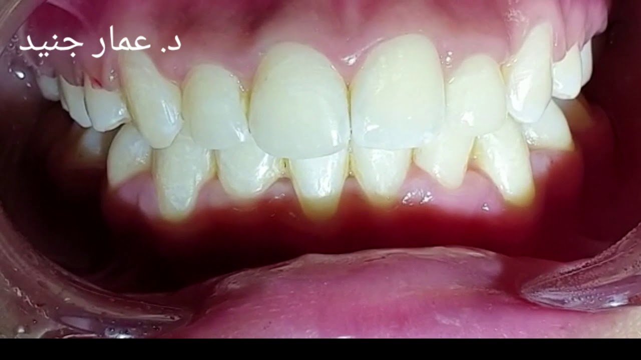 شكل الاسنان بعد سنتين تقويم