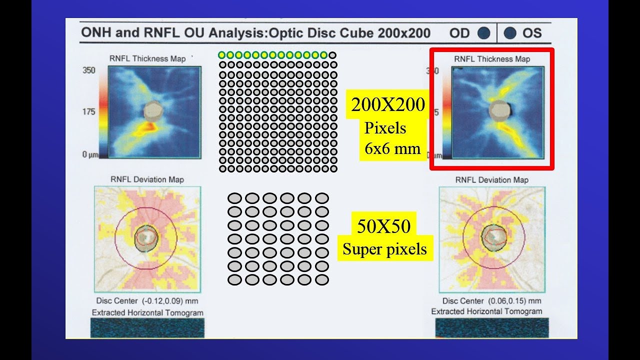 2021 OCT in Glaucoma (2) Comparing OCT machines