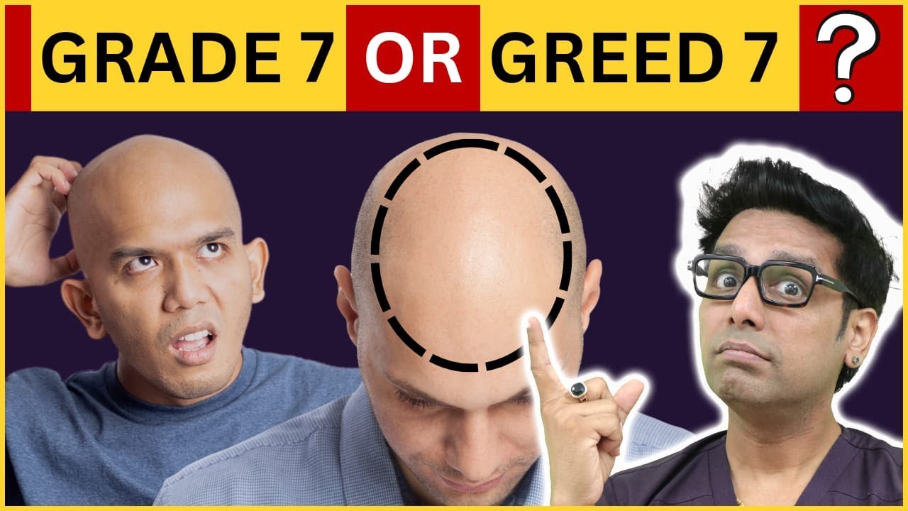 Grade 7 results | Hair Transplant Results | Grade 7 Hair Transplant | Grade 7 Baldness | FUE | SATYA