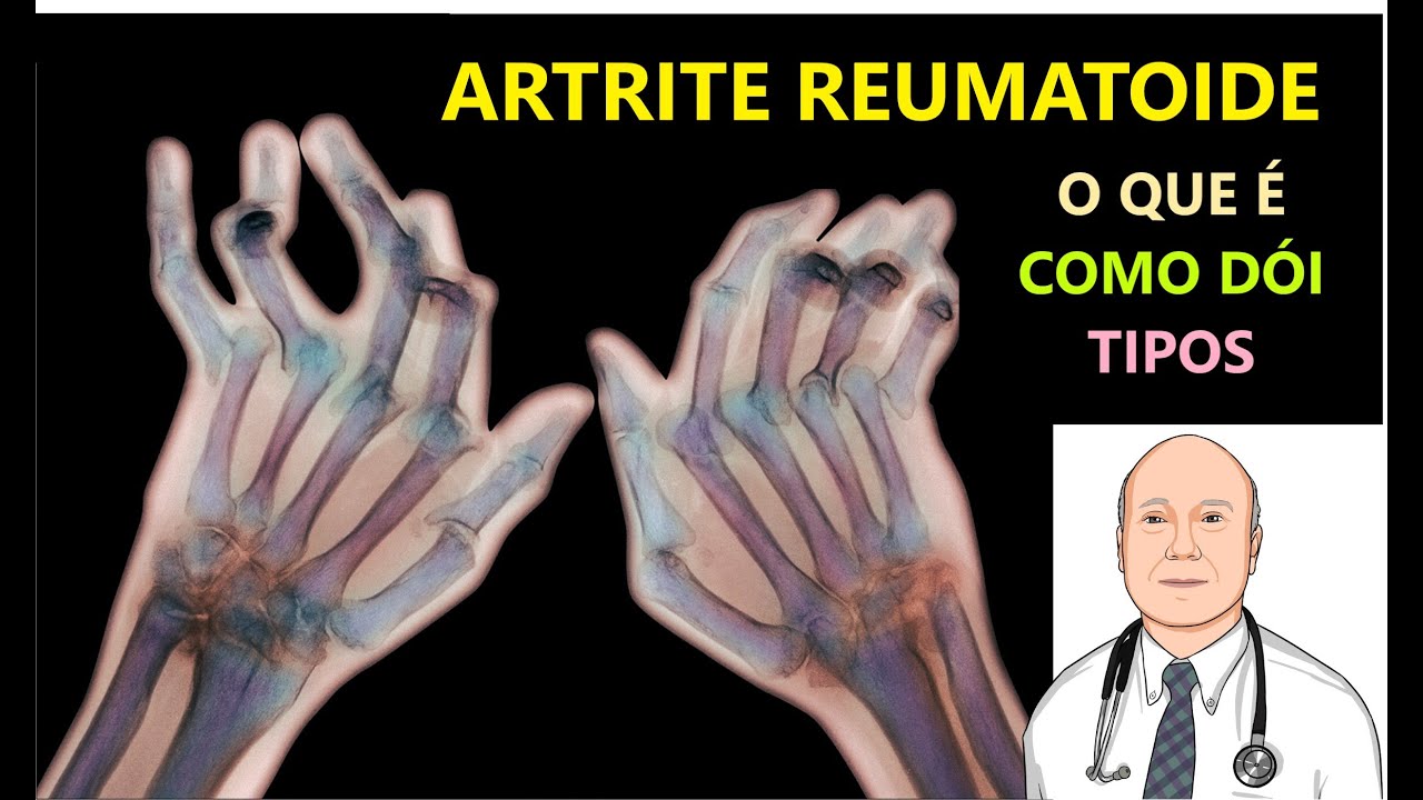 DORES DA ARTRITE Reumatoide, causas, tipos e diagnóstico precoce.
