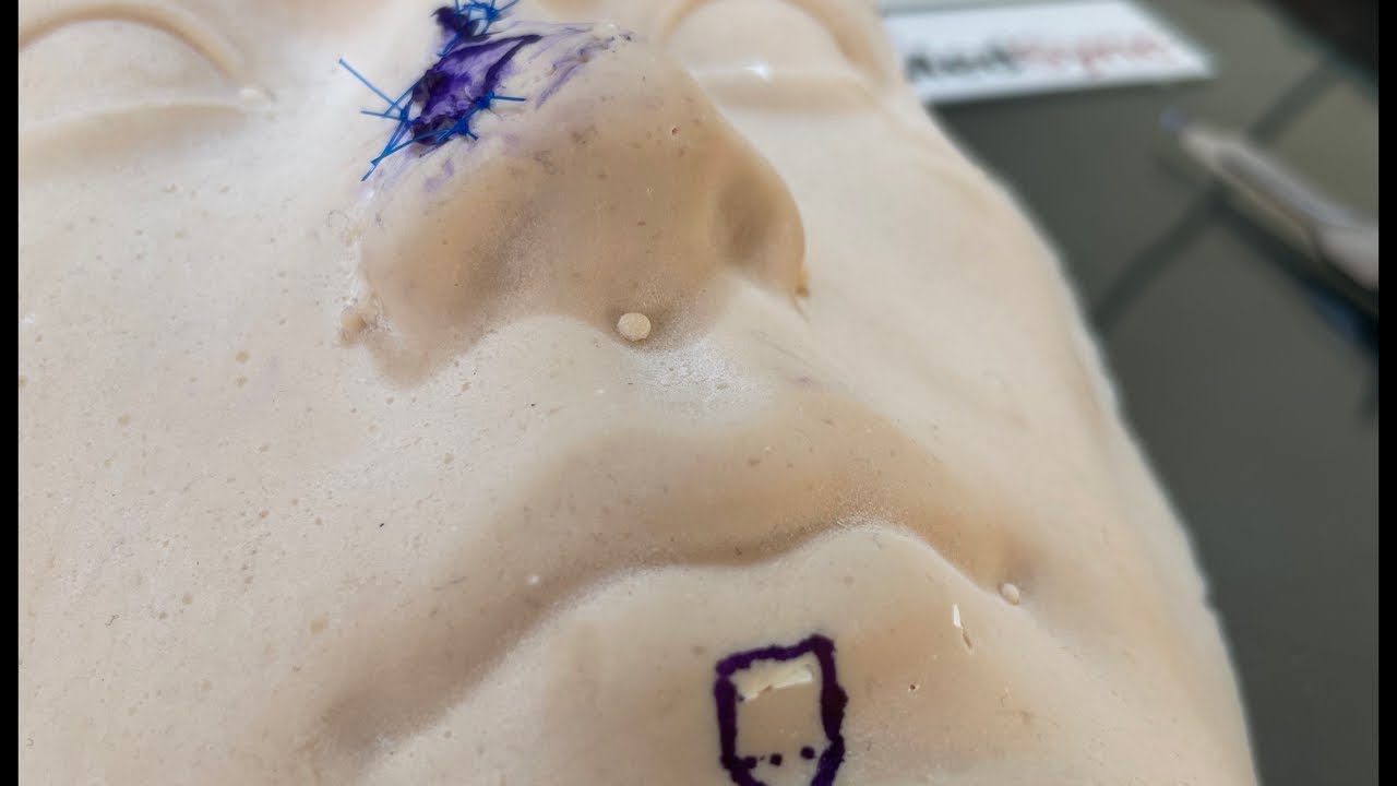 Local flaps on the face: The Rhomboid flap