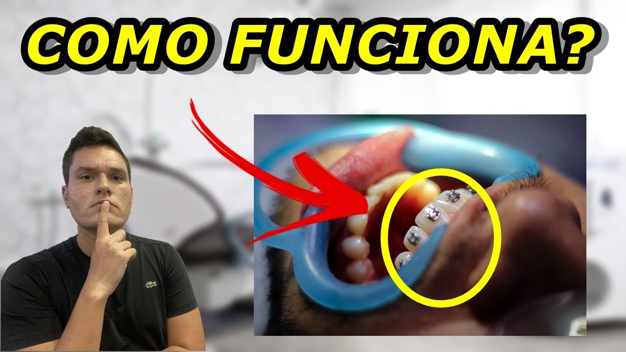 COMO FUNCIONA A MANUTENÇÃO DO APARELHO ORTODÔNTICO? | O QUE O DENTISTA FAZ | PASSO A PASSO!!!