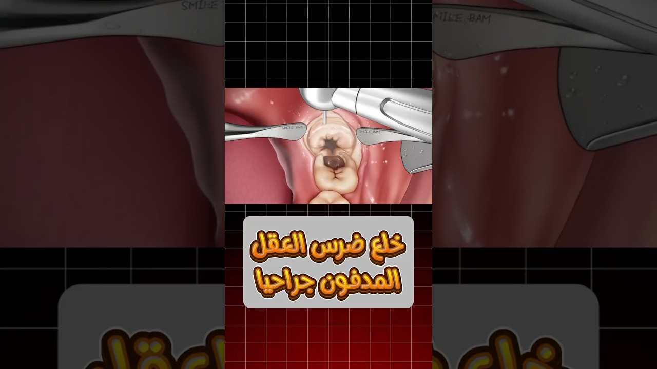 خلع ضرس العقل المدفون جراحيا 🫣 خطوات سهلة وبسيطة 🤓