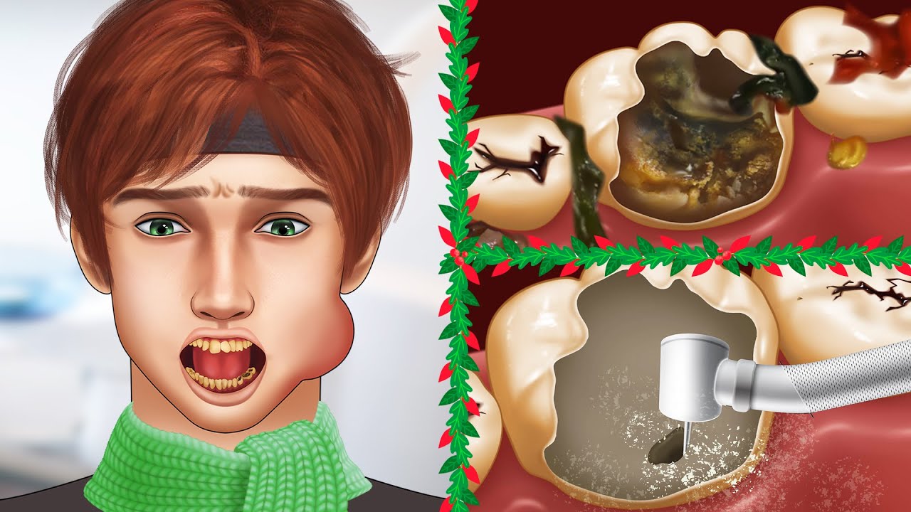 ASMR Christmas - Deep cleaning big decay tooth | Dental care animation