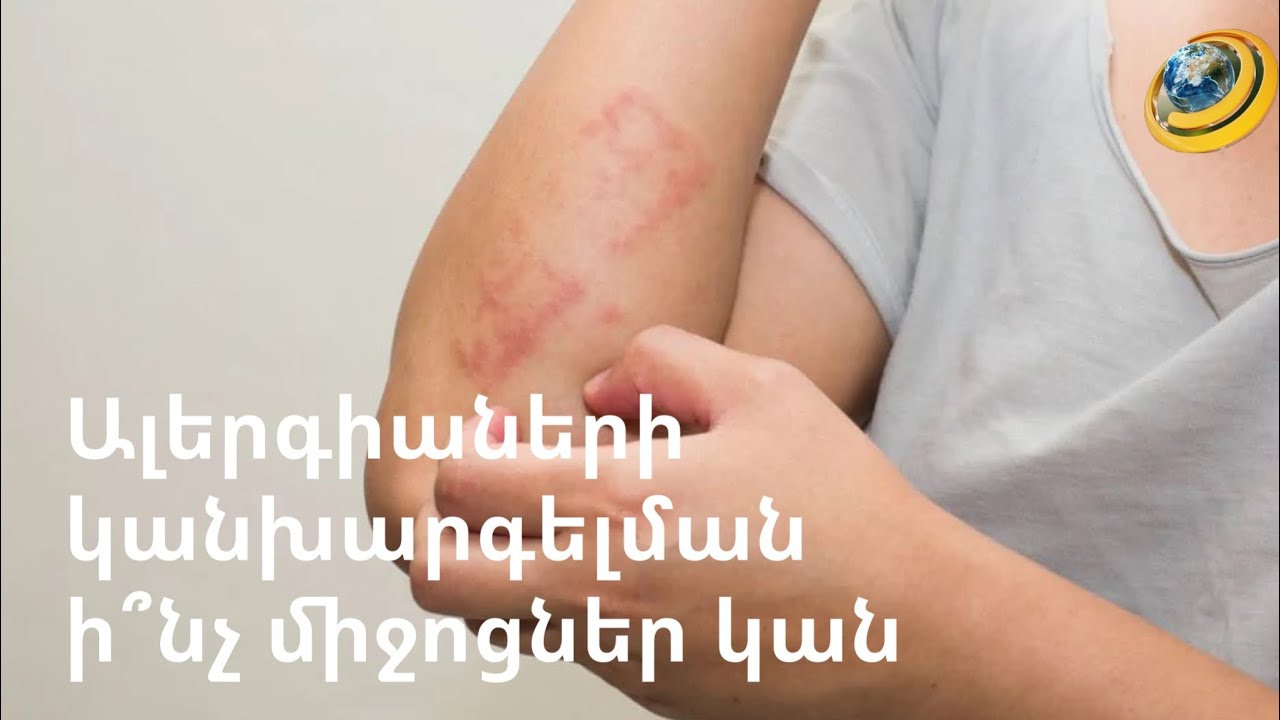 Ալերգիաների կանխարգելման ի՞նչ միջոցներ կան