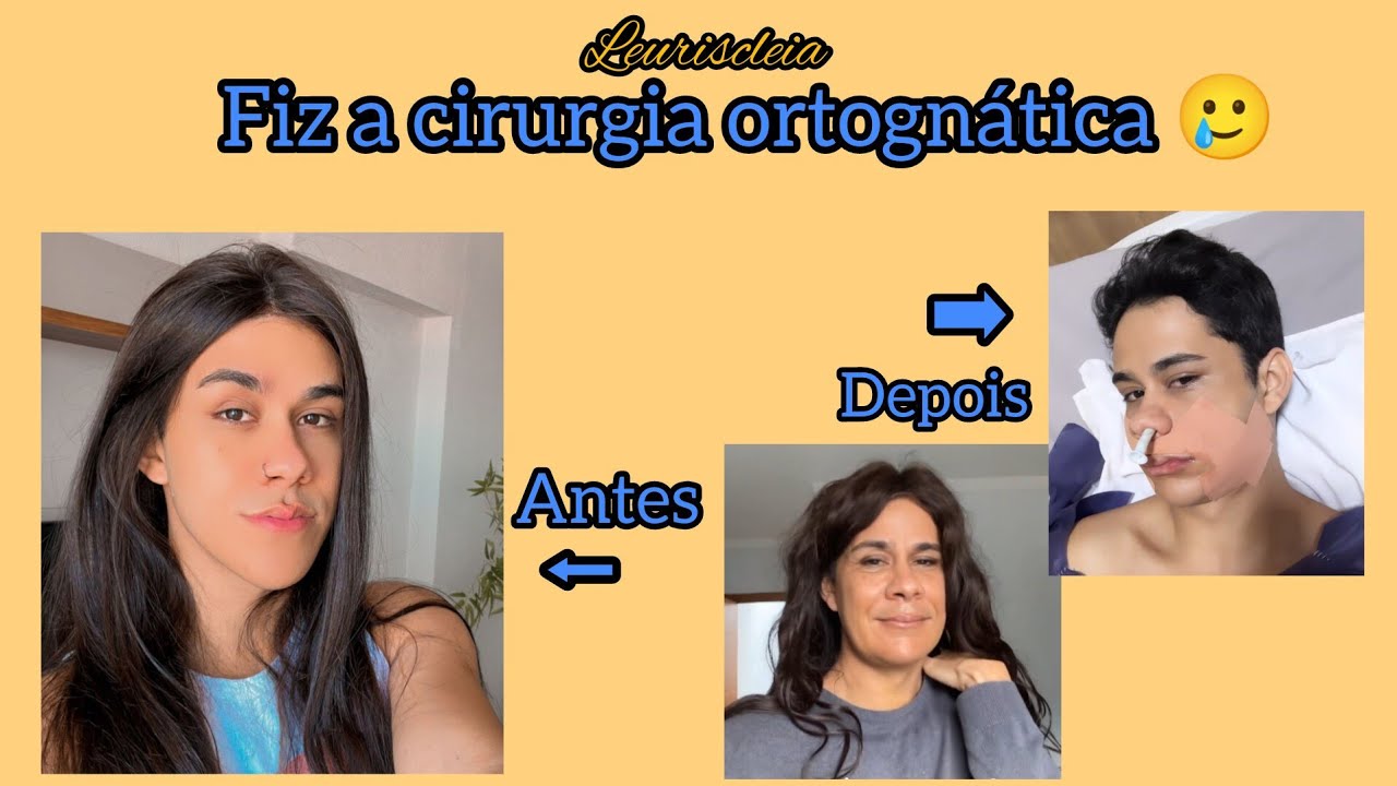 LEURISCLEIA FEZ A CIRURGIA ORTOGNÁTICA #leuriscleia #humor #autoestima #estetica