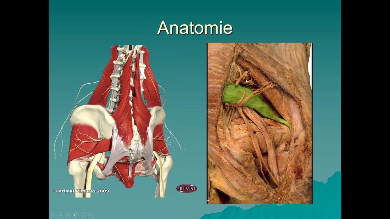 syndrome du piriforme