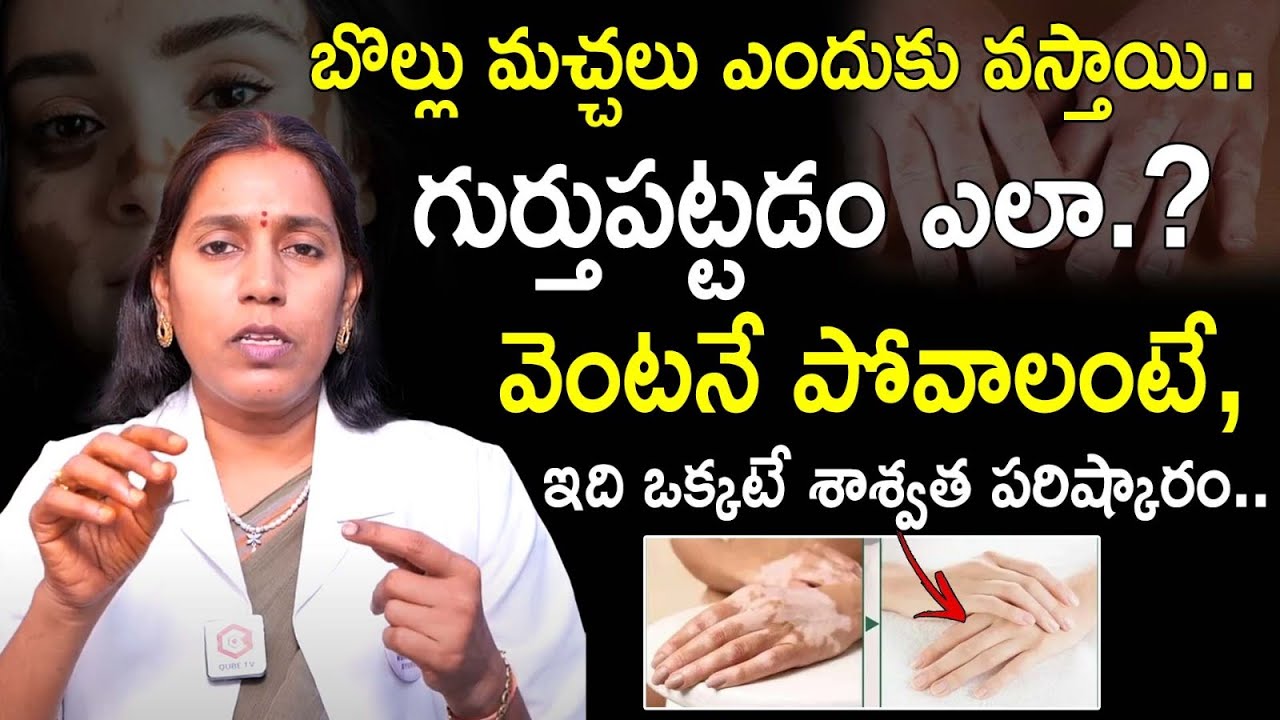 బొల్లి మచ్చలు ఎందుకు వస్తాయి..? : Vitiligo - Vitiligo Causes And Symptoms In Telugu | QubeTV Health