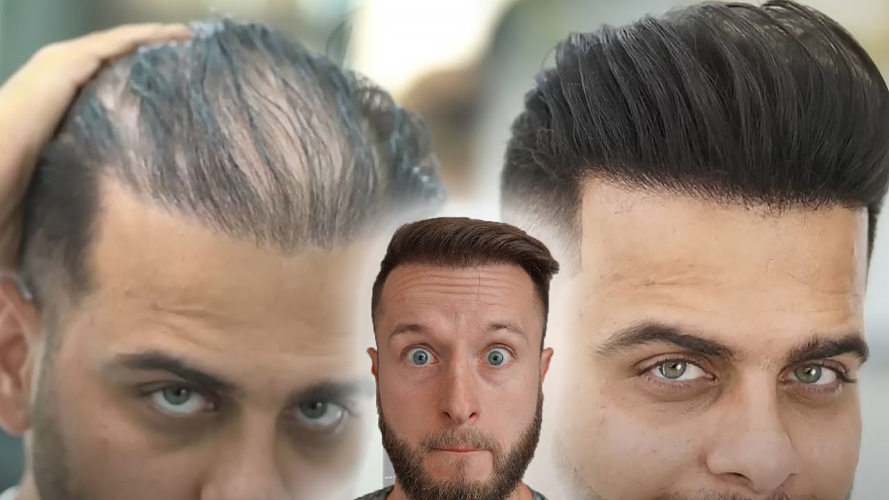 Can Hair Fibers Save a NW6 with Diffuse Hair Loss!?