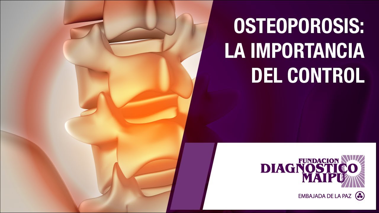 Charla: Osteoporosis: La importancia del Control