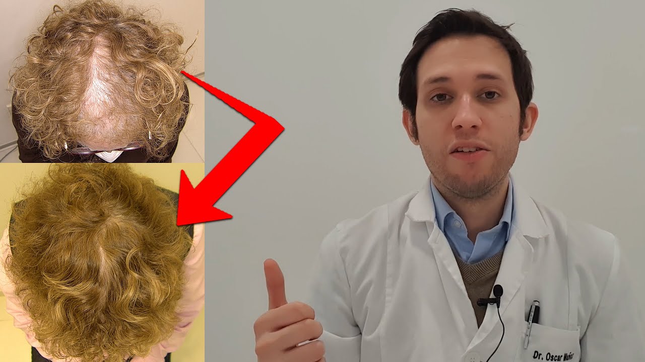 Recuperar tu pelo frontal : trasplante en mujer
