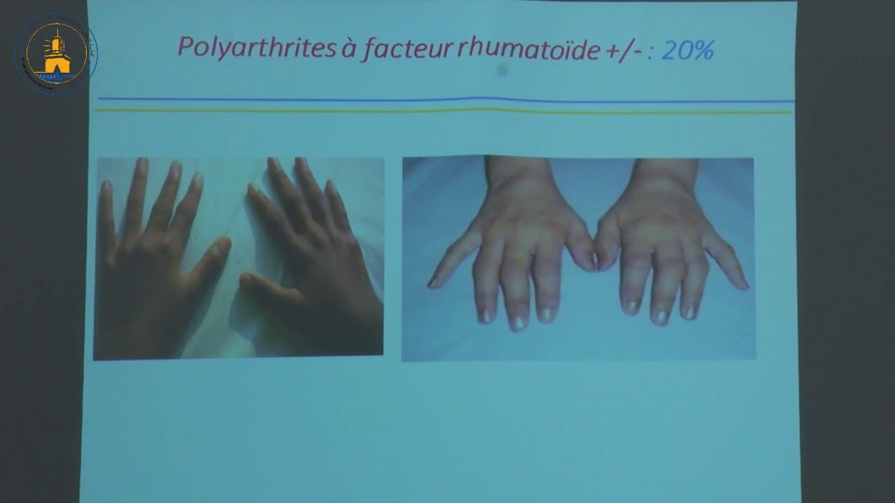 Les Arthrites Juvéniles Idiopathiques 5