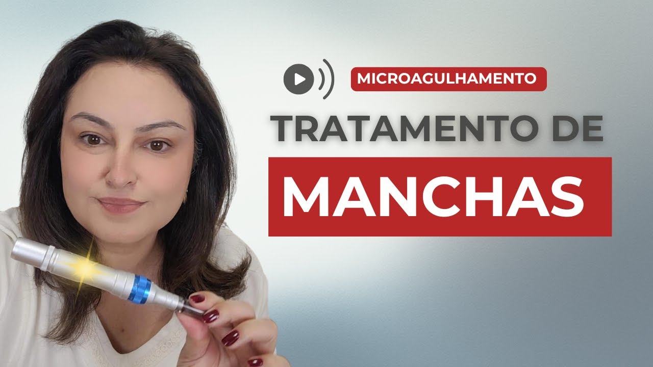 Microagulhamento para MANCHAS : O Que Funciona (E O Que Pode PIORAR!)