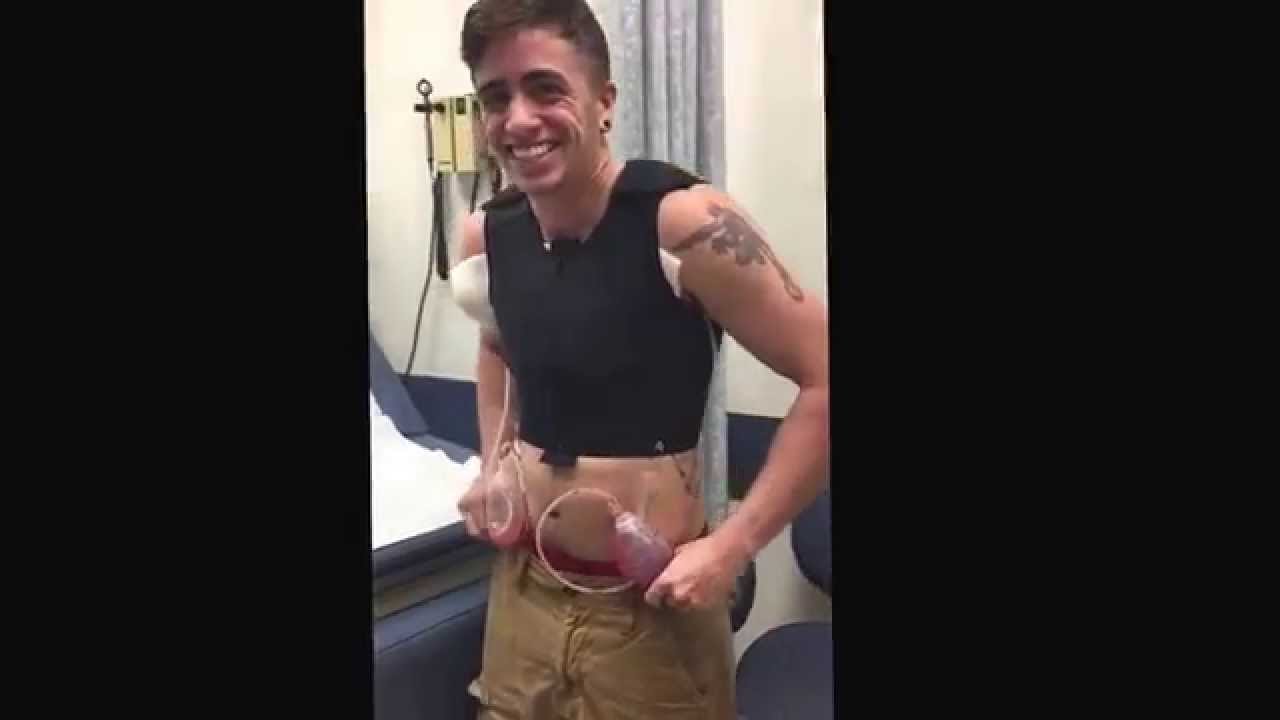 Top Surgery - Reveals and Feels - FTM Transguy