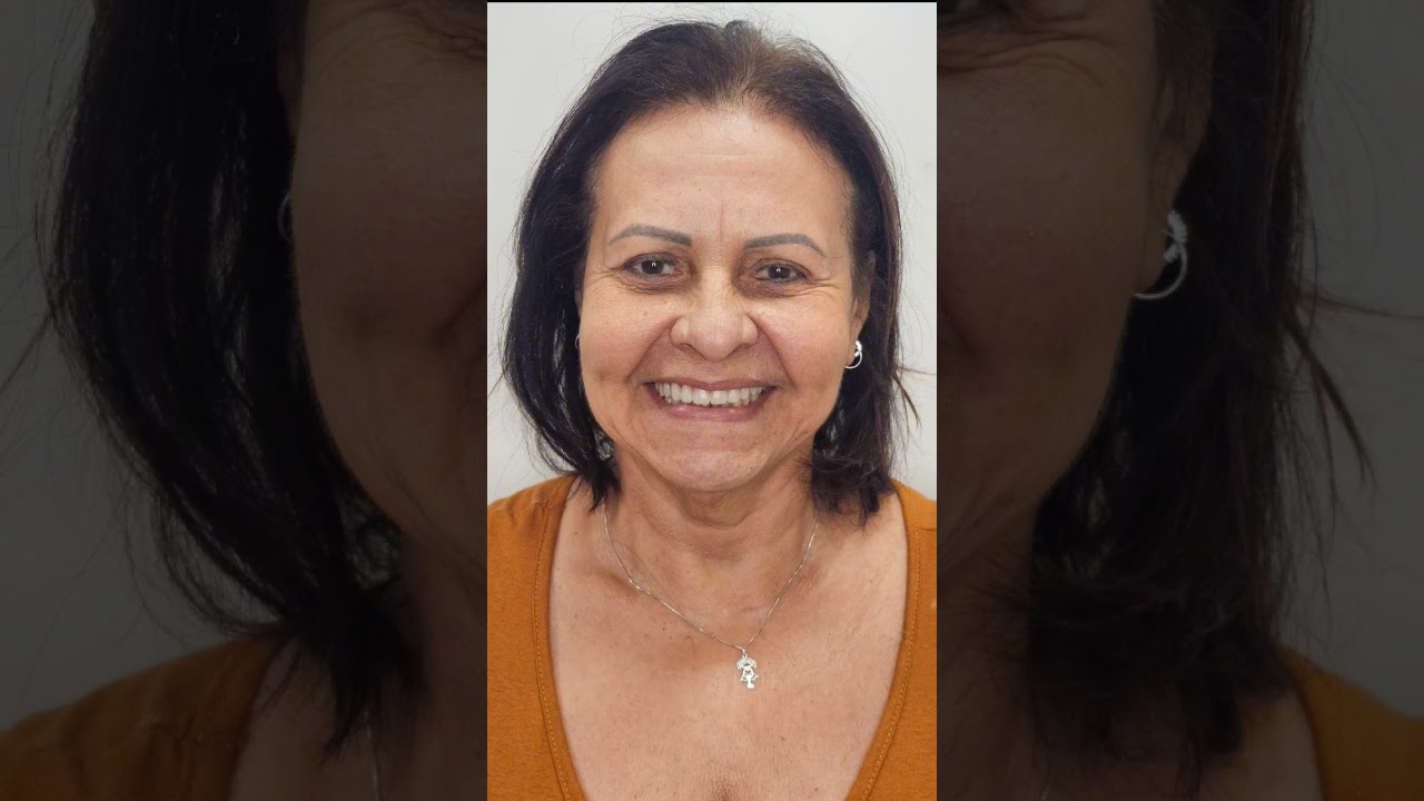 ANTES E DEPOIS PR&Oacute;TESE PROTOCOLO SUPERIOR #odontologia