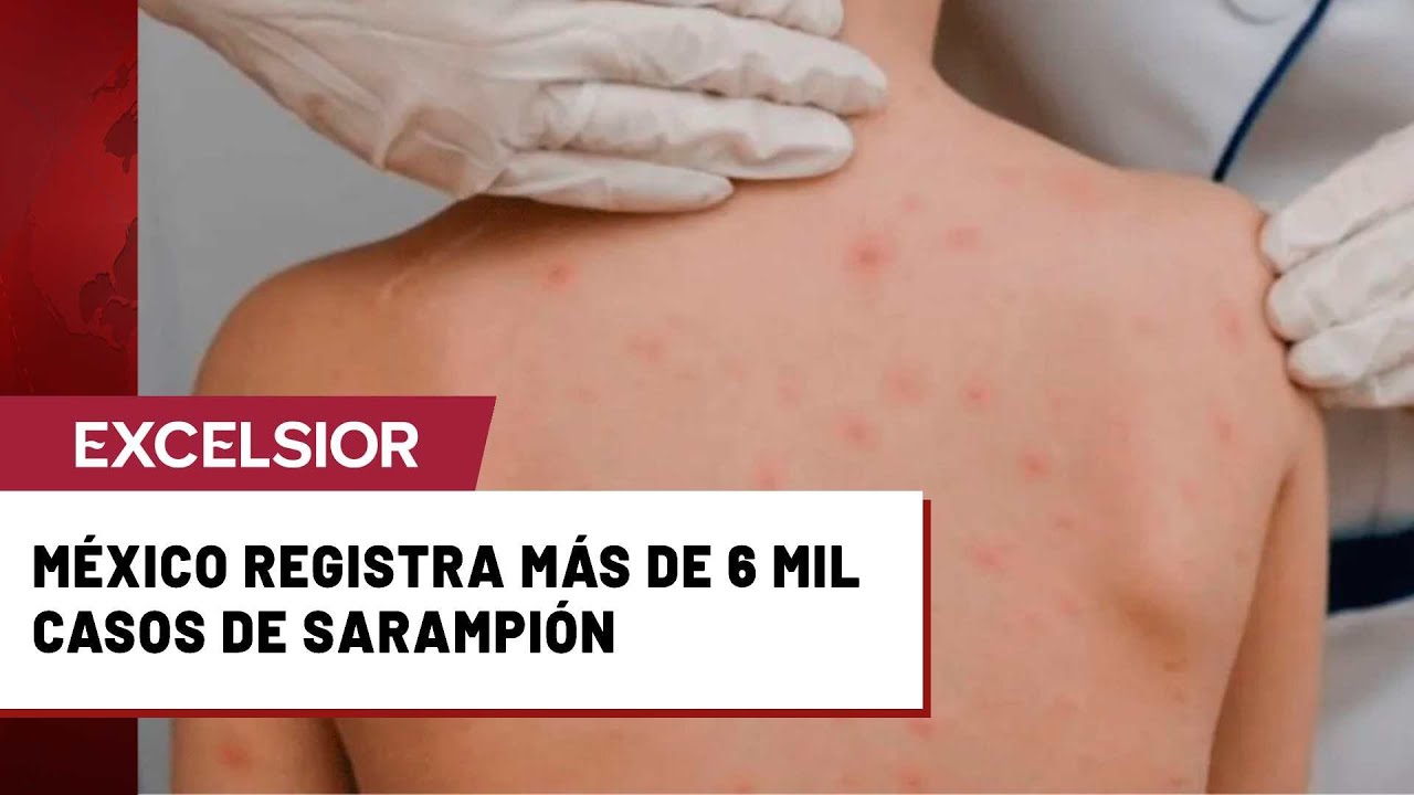 M&eacute;xico arranca el 2026 con repunte en casos de sarampi&oacute;n