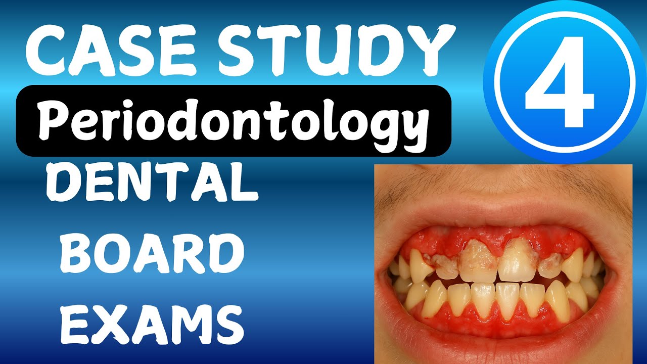 High-Yield Periodontology Case Study 4 | Exam Prep for INBDE, AFK, ORE, LDS,  MFDS, ADC #dentospedia