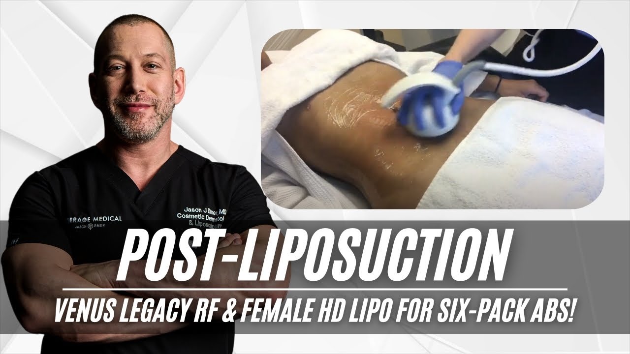 Post Liposuction | Venus Legacy RF | Female HD Lipo | Six Pack | West Hollywood, CA | Dr. Jason Emer
