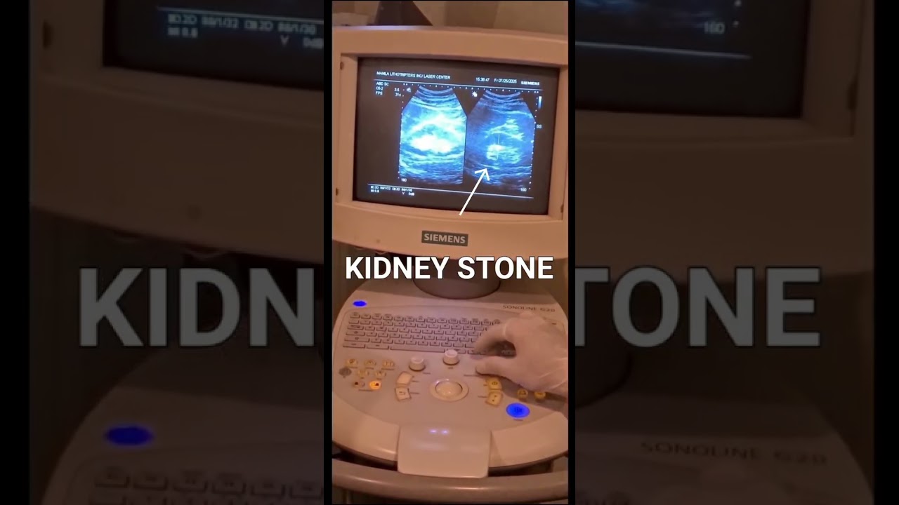 Extracorporeal Shock Wave Lithotripsy (ESWL)