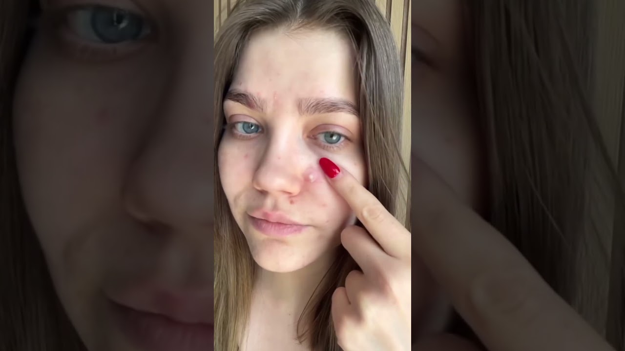 Ogarniamy podsk&oacute;rnego i bolesnego pryszcza w 2 dni