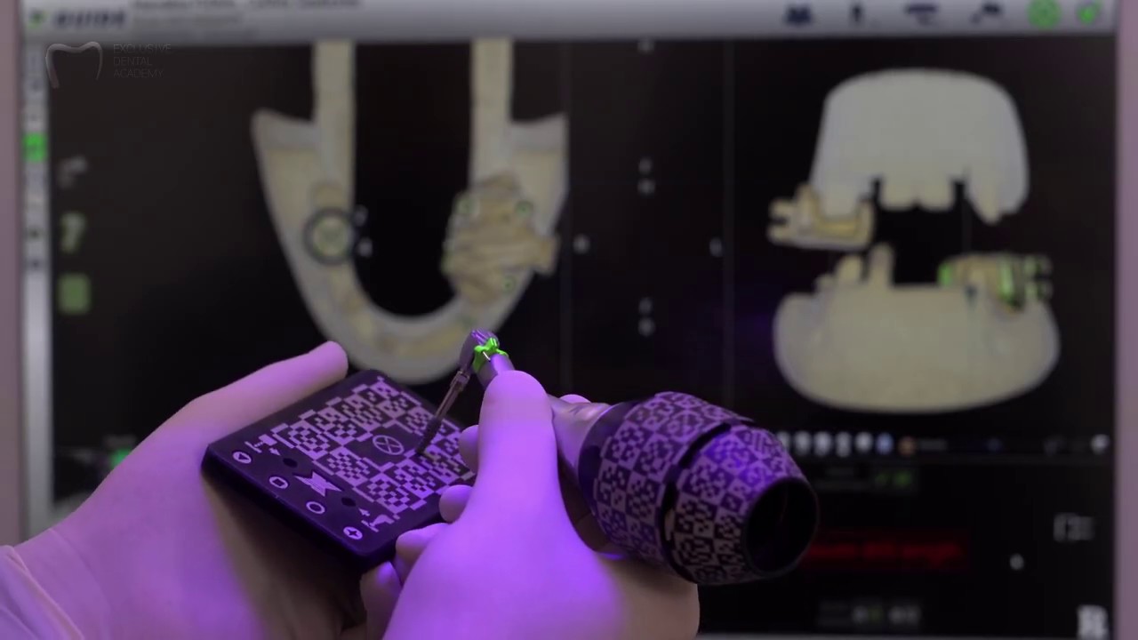 X-Guide&trade; implant and drill calibration