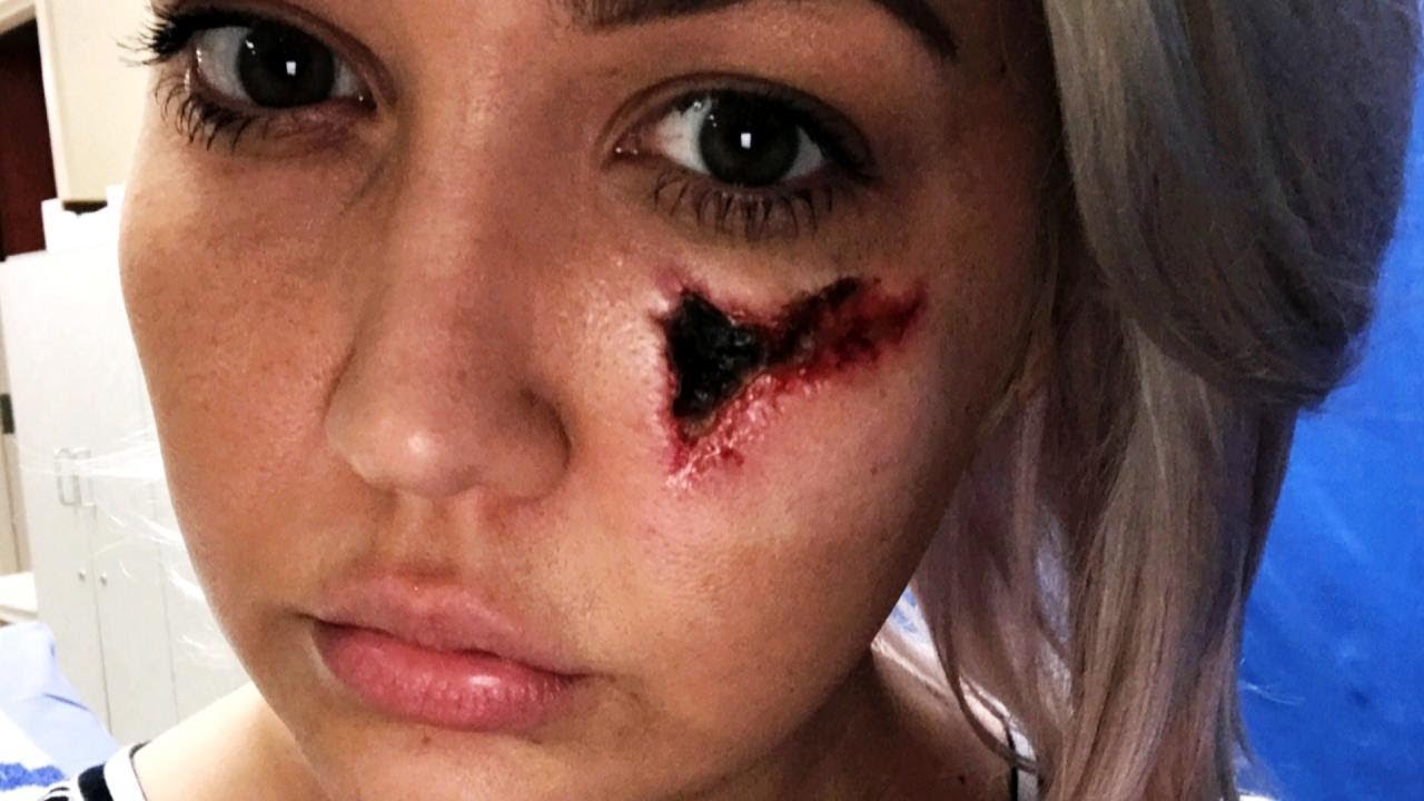 &lsquo;The Voice&rsquo; Contestant Faces Brown Recluse Spider Bite