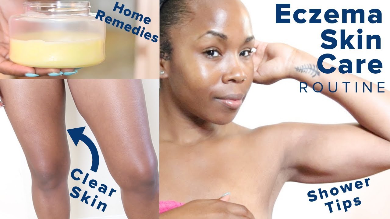 Eczema Skin Care & Shower Routine Tips | Get Rid of Dry Skin & Hyperpigmentation on Legs, Face, Body