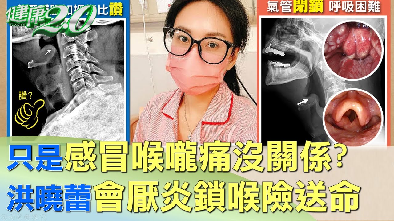 只是感冒喉嚨痛沒關係？洪曉蕾會厭炎鎖喉險送命 健康2.0