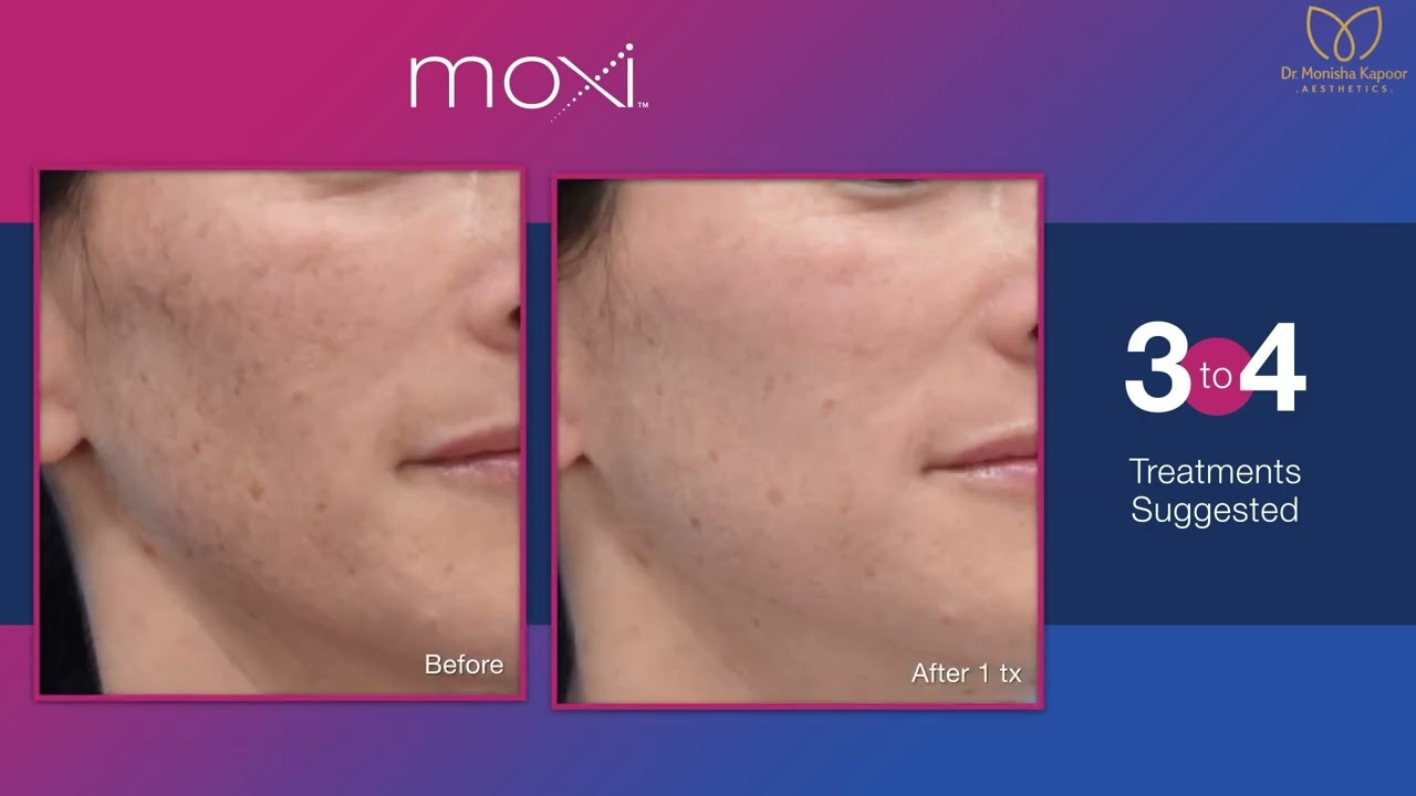 Sciton Moxi laser treatment in India at Dr. Monisha Kapoor Aesthetics
