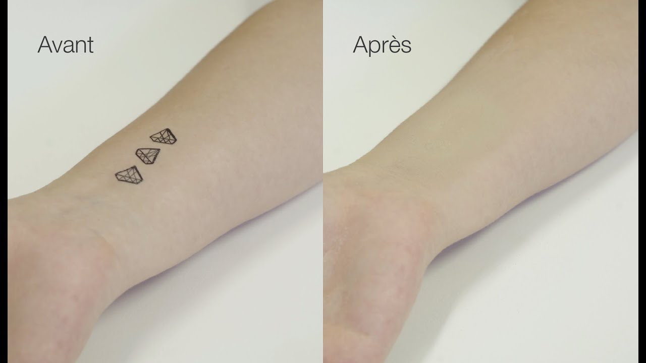Covermark - Comment camoufler un tatouage ?