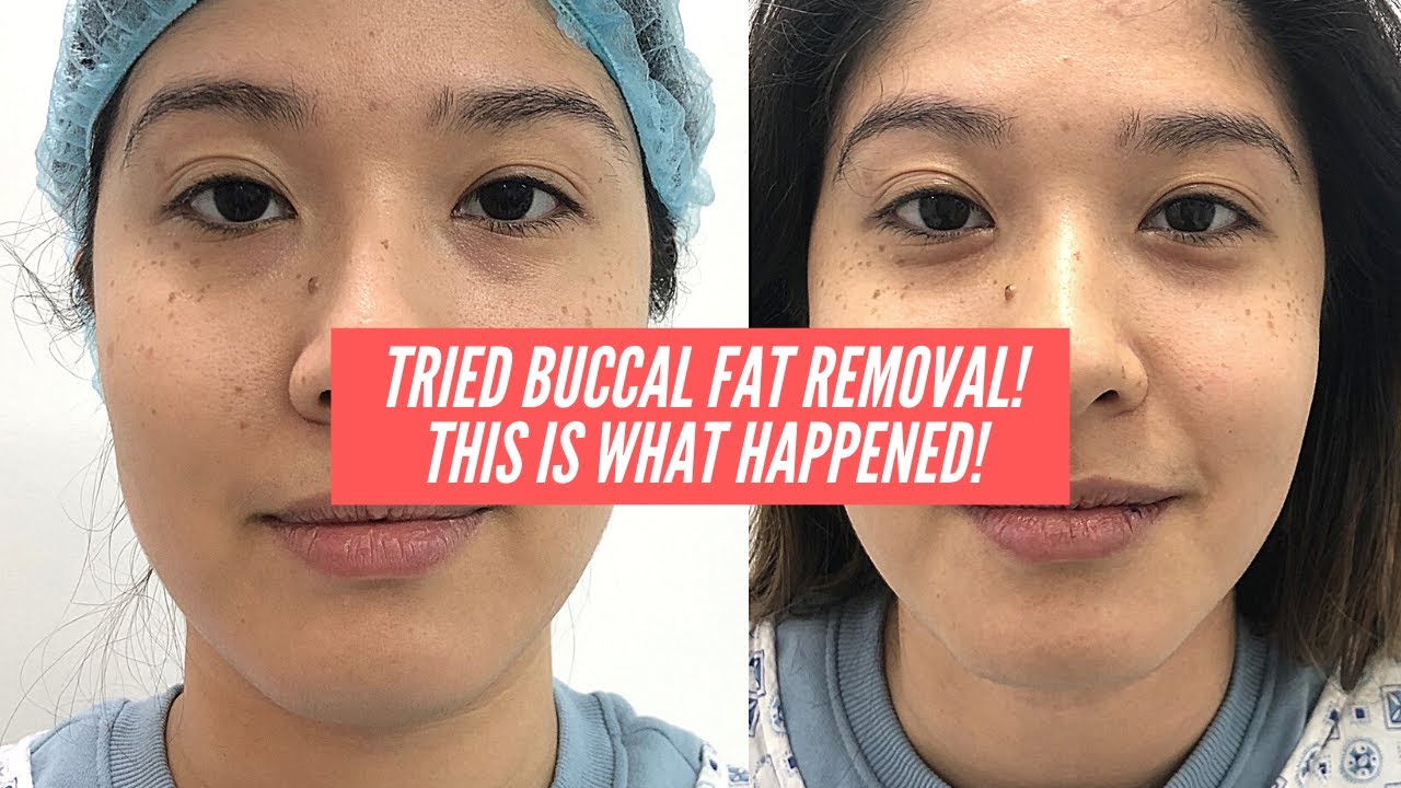 JOURNEY TO A SLIMMER FACE PART 1- BUCCAL FAT REMOVAL