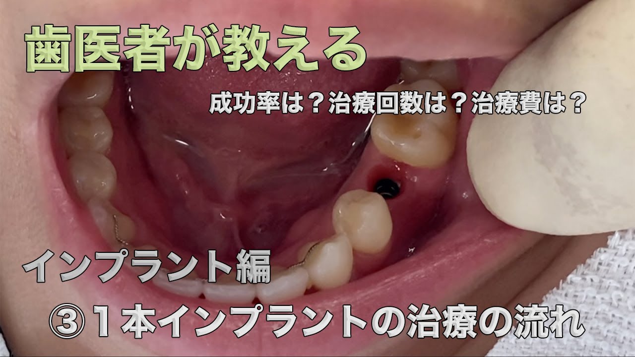 １本インプラントの治療の流れを８分にまとめました。