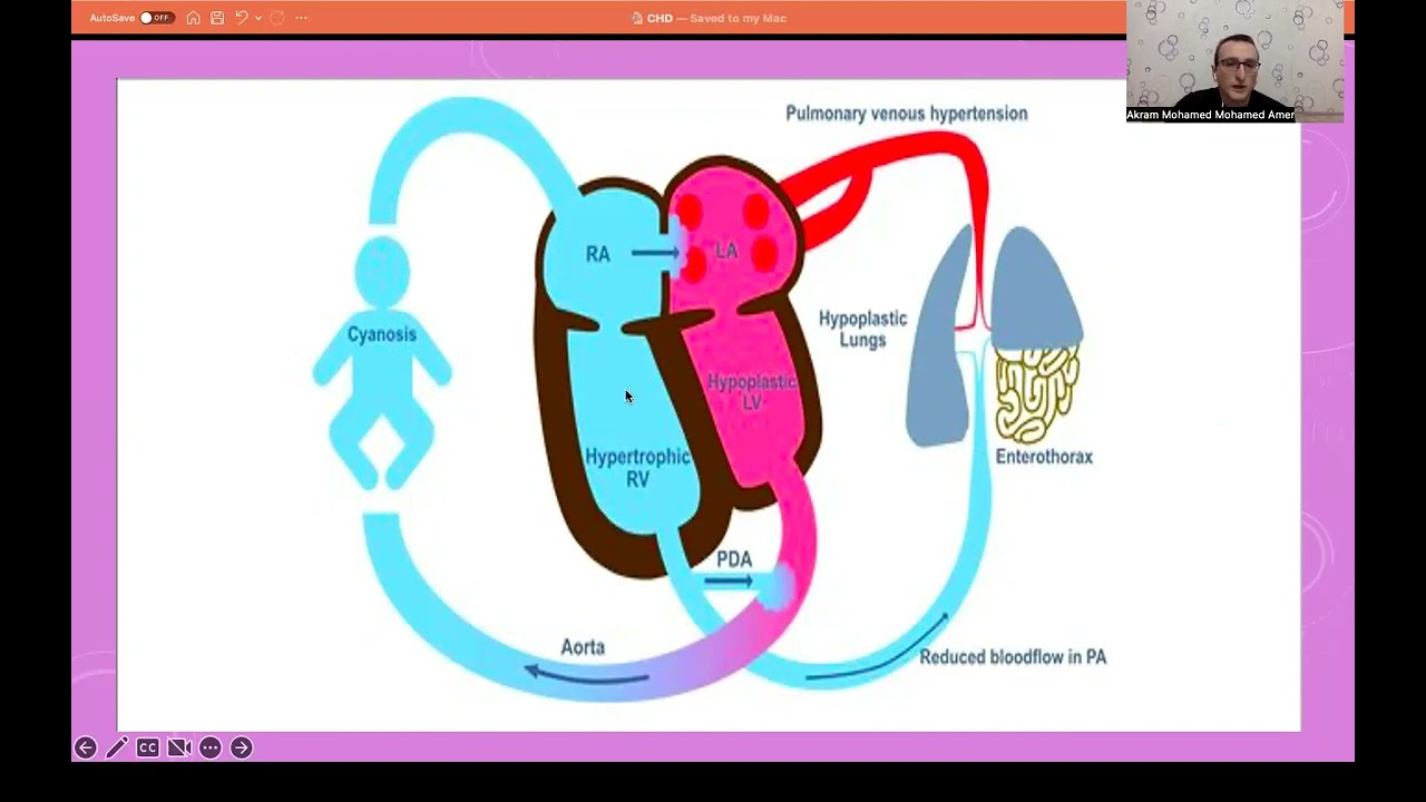 Anesthesia for Congenital Diaphragmatic Hernia (CDH), Part-1
