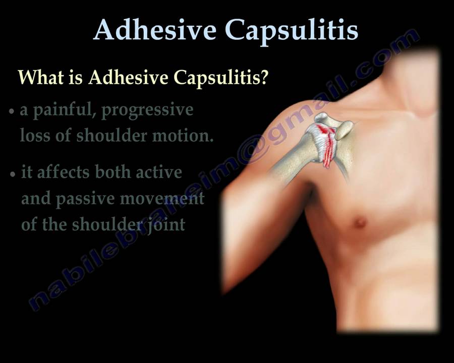 Adhesive Capsulitis ,frozen shoulder. - Everything You Need To Know - Dr. Nabil Ebraheim