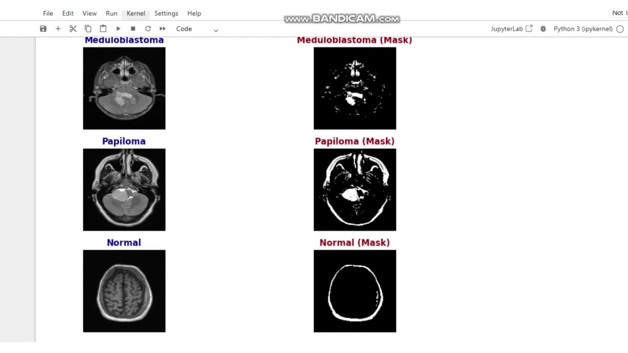 DENSENET 121 BASED DEEP LEARNING MODEL FOR ACCURATE BRAIN TUMOR SEGMENTATION AND CLASSIFICATION
